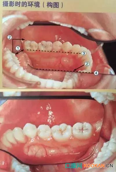 拍不好口腔照片怎么辦？這些口腔攝影方法與技巧請(qǐng)收好！