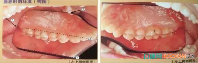 拍不好口腔照片怎么辦？這些口腔攝影方法與技巧請(qǐng)收好！