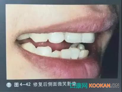 拍不好口腔照片怎么辦？這些口腔攝影方法與技巧請(qǐng)收好！
