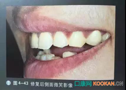 拍不好口腔照片怎么辦？這些口腔攝影方法與技巧請(qǐng)收好！