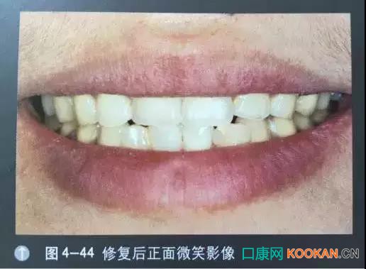 拍不好口腔照片怎么辦？這些口腔攝影方法與技巧請(qǐng)收好！