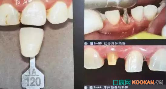 拍不好口腔照片怎么辦？這些口腔攝影方法與技巧請(qǐng)收好！